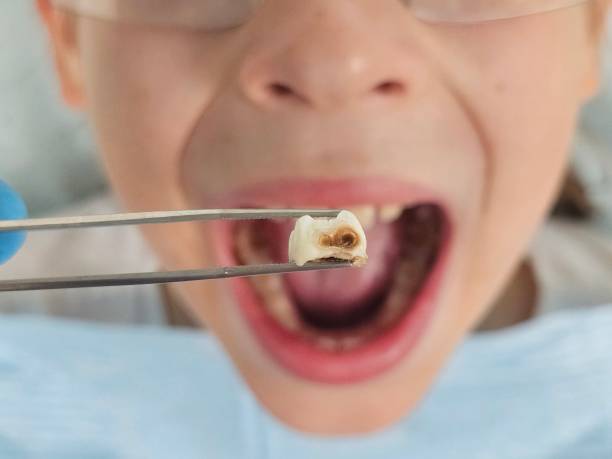 Best Knocked-Out Tooth (Avulsed Tooth) Treatment in Agler Beach, FL